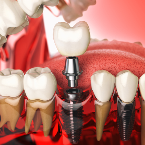 Powell Family Dentistry - Implants in Powell Tennessee